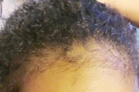 Alopécie post partum sur cheveux crépu