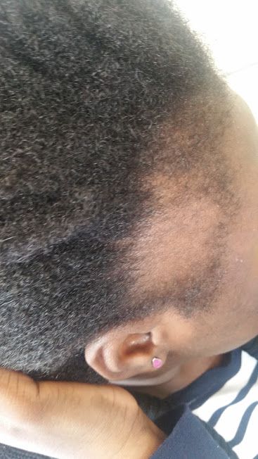 alopécie sur cheveux crépus