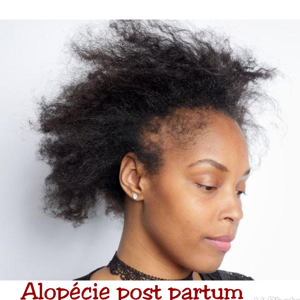 Alopécie post partum